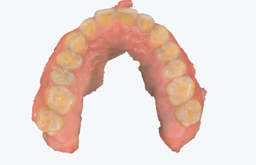 口腔内スキャナーのデータ