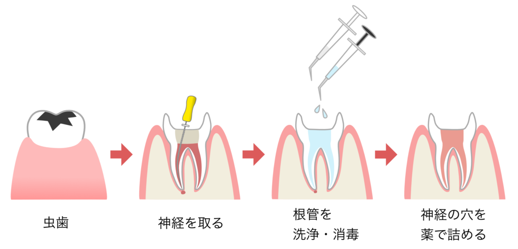 抜髄治療の流れ