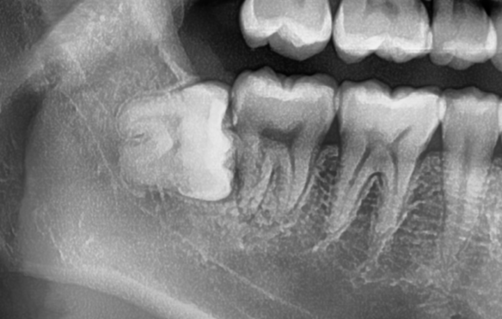 下顎水平埋伏智歯の様子(親知らず)