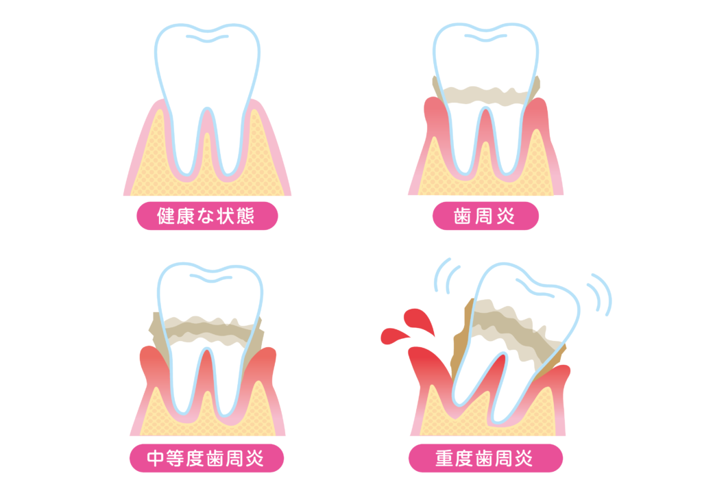 歯周病とは？：歯を支える組織が破壊される病気 ～ 歯肉炎から歯周炎へ、静かに忍び寄る恐怖