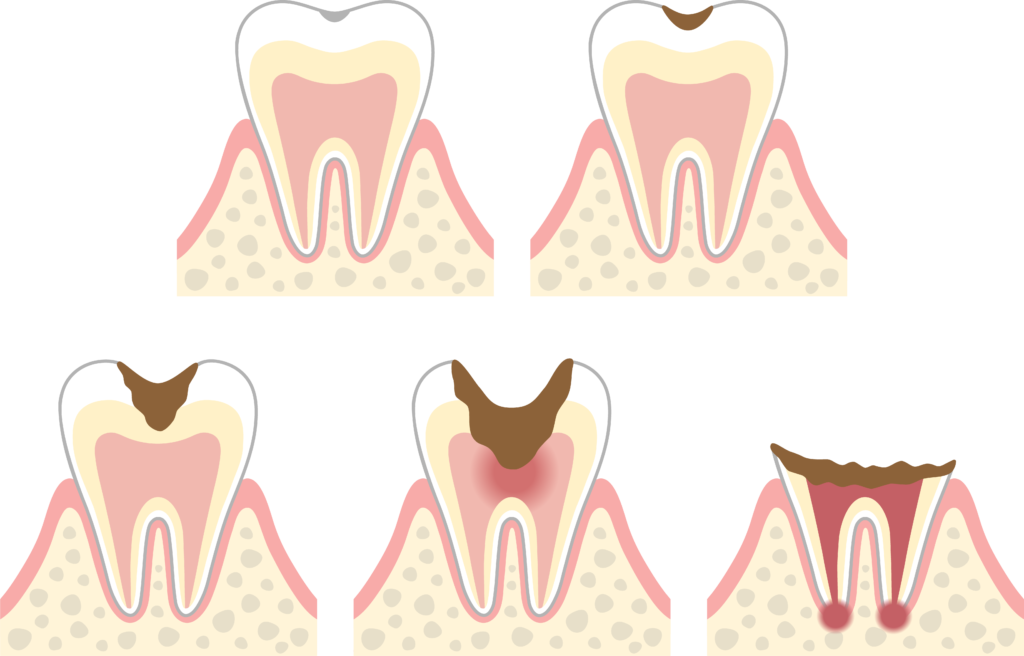 虫歯とは？：歯を溶かす恐ろしいメカニズム ～ エナメル質から歯髄まで、段階的な破壊プロセスを追う